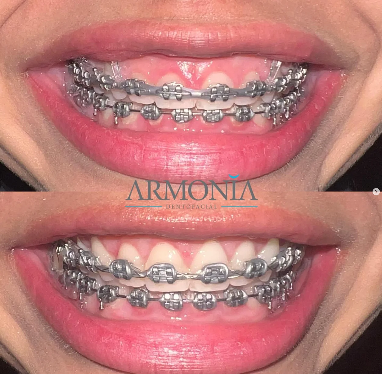 Evolución con brackets