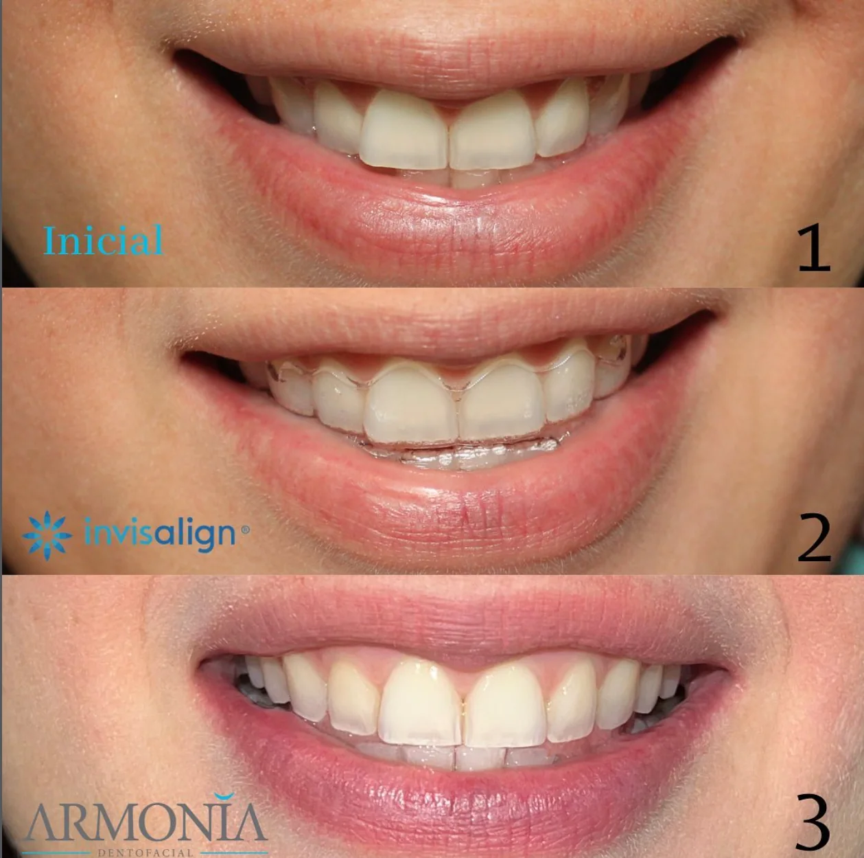 Invisalign Armonía Dentofacial
