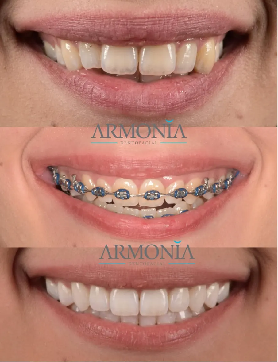 Caso sonrisa