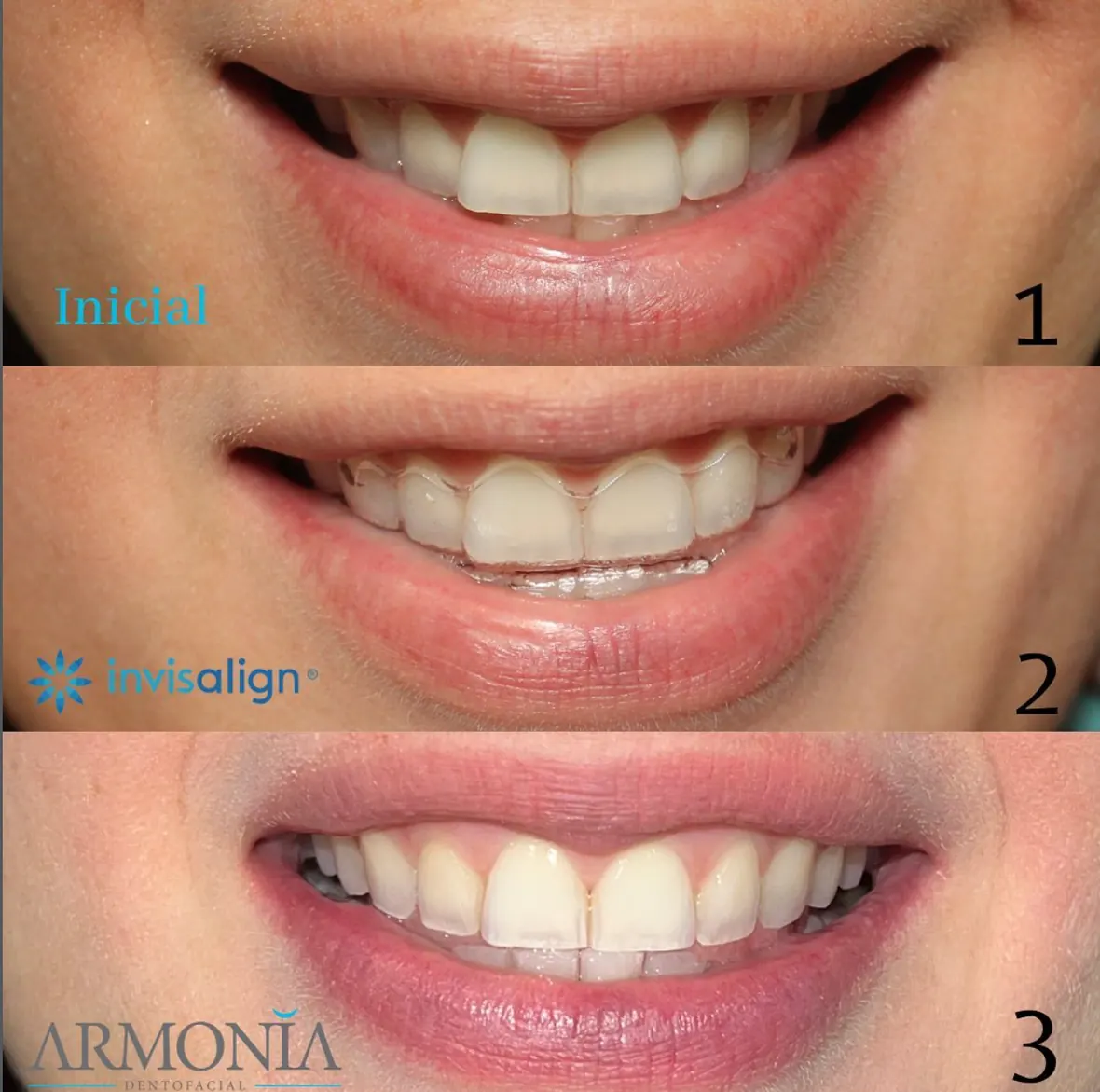 Invisalign