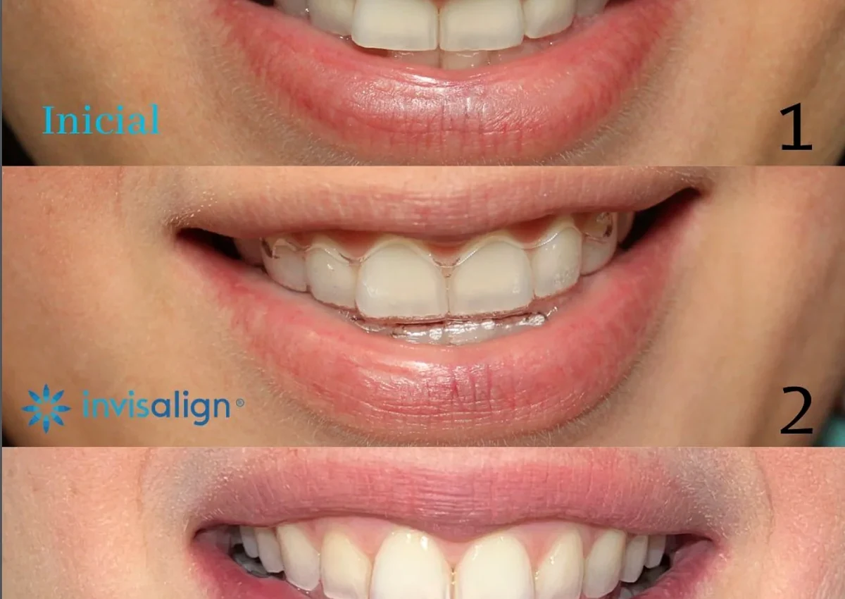 Ruta de estética dental